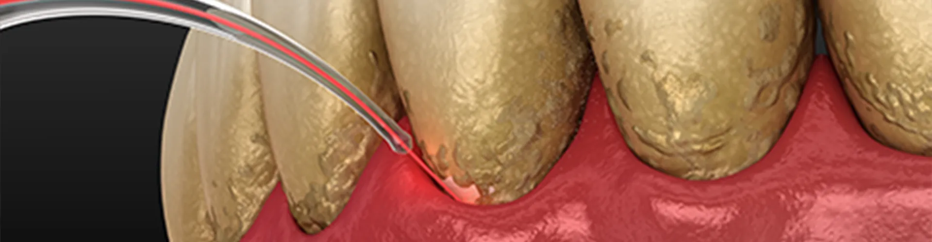 Rendering of dental laser removing buildup from teeth.