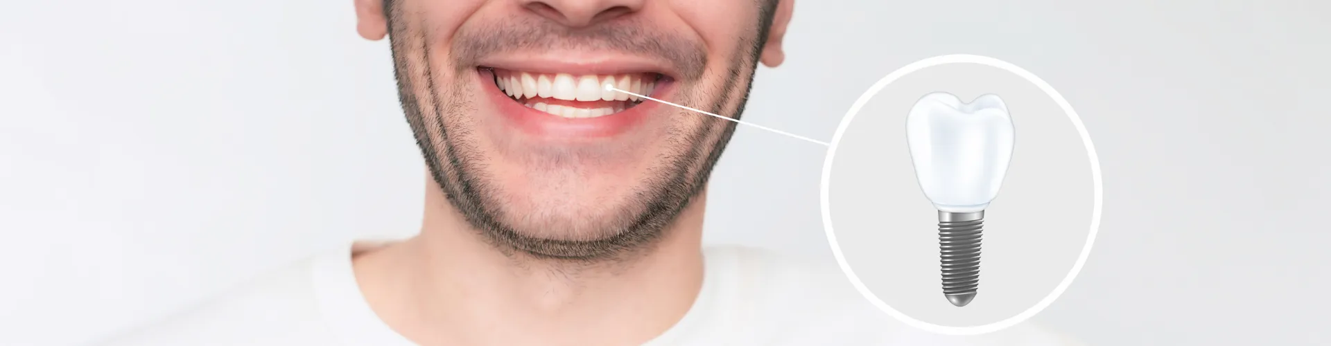 Implant model on shoulder of smiling man.