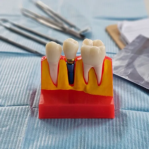model of a dental implant between two teeth