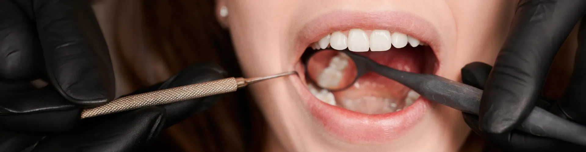 Dentist using tools for a cavity filling for a Woodland Hills patient.