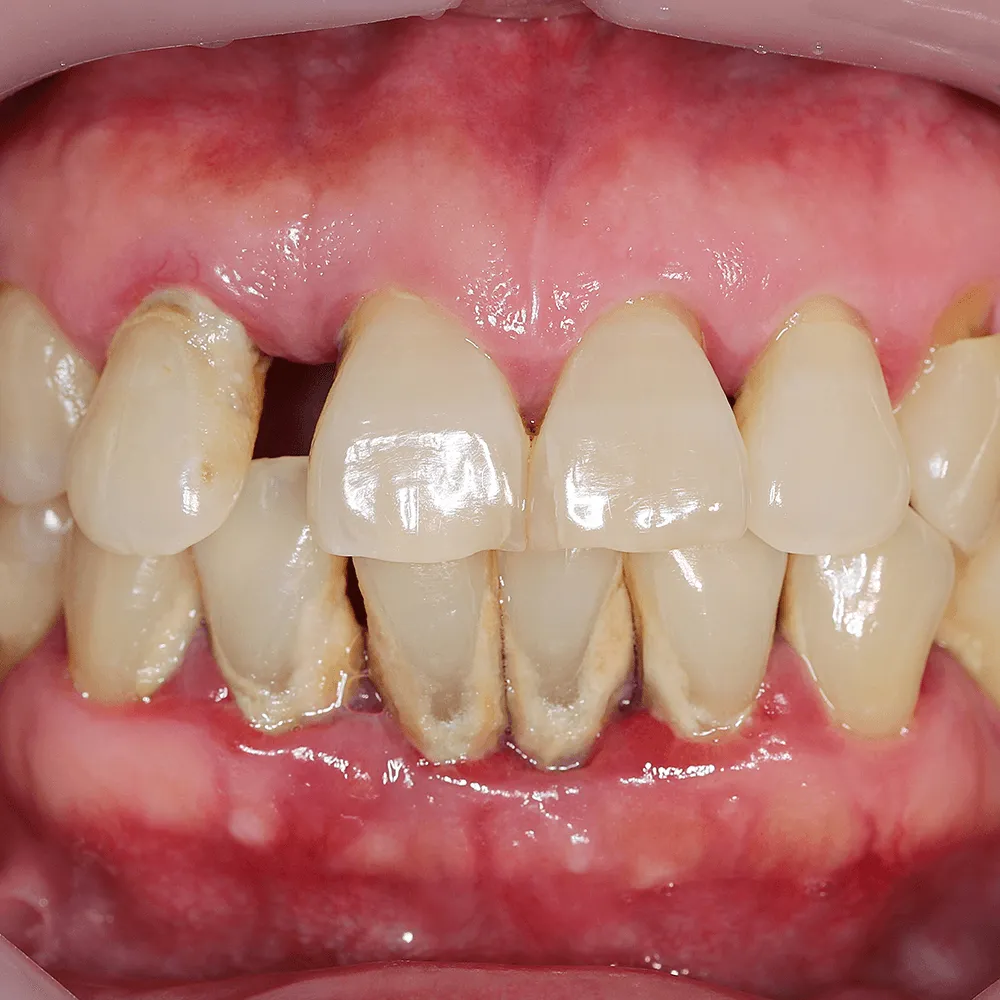 Close-up of teeth with gum recession and staining.