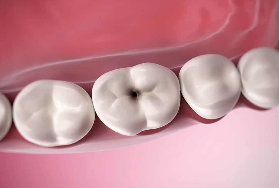 Raising Tooth Decay Awareness