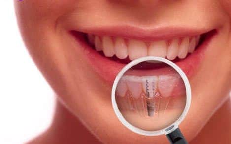 Getting To Know Dental Implants