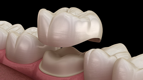 Understanding Dental Crowns