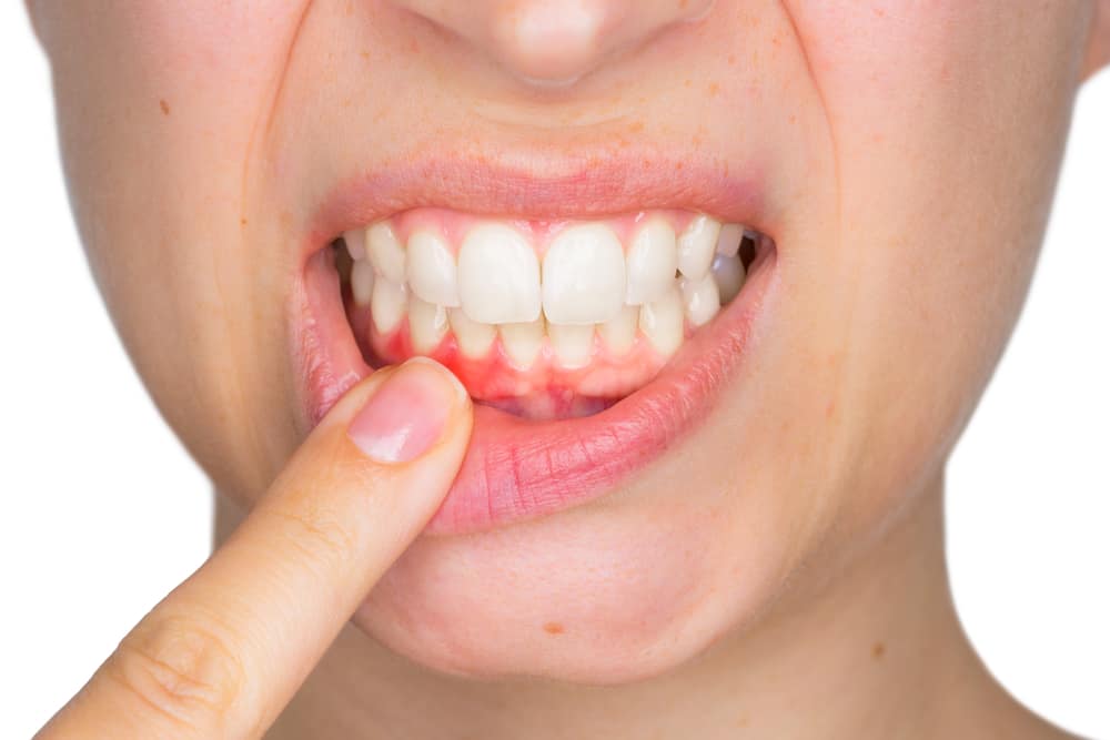 The Basics of Gum Disease
