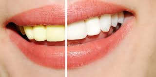 How Does Teeth Whitening Work?