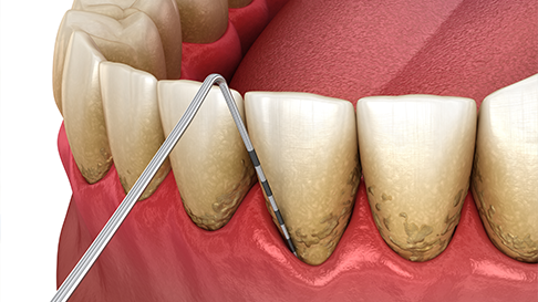 The Silent Threat to Your Smile: What You Should Know About Periodontal Disease